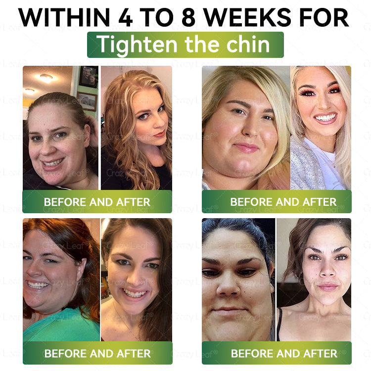 𝐂𝐫𝗮𝐳𝐲𝗟𝗲𝐚𝗳® 𝑆𝑀𝐺𝑇-𝐺𝐿𝑃-1 𝘕𝘢𝘯𝘰 𝘔𝘪𝘤𝘳𝘰𝘯𝘦𝘦𝘥𝘭𝘦 𝘗𝘢𝘵𝘤𝘩 with Collagen & Matrixyl 3000 丨Targets Obesity, Loose Skin, High Blood Pressure, Diabetes, Fatty Liver, Joint Pain, Brain Fog, Low Energy, Body Aches, and More