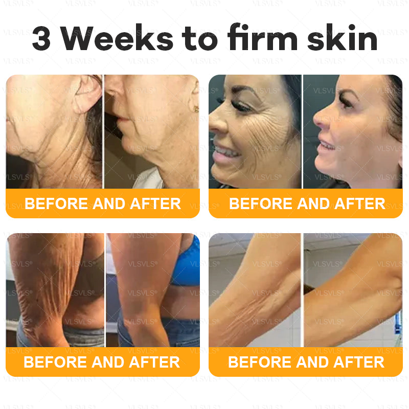 𝐕𝐋𝐒𝗩𝗟𝗦® 𝐁𝐞𝐞 𝐕𝐞𝐧𝐨𝐦 𝐒𝐤𝐢𝐧 𝐑𝐞𝐬𝐭𝐨𝐫𝐚𝐭𝐢𝐨𝐧 𝐂𝐫𝐞𝐚𝐦 👑 Anti-aging,Hydrating, Skin Repair, Even Tone, Acne and Dark Spot Treatment, Wart and Mole Removal, Psoriasis Relief 🗽