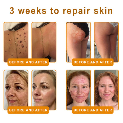 𝙑𝙇𝙎𝙑𝙇𝙎® 𝘽𝙀𝙀 𝙑𝙀𝙉𝙊𝙈 𝑺𝒌𝒊𝒏 𝑹𝒆𝒔𝒕𝒐𝒓𝒂𝒕𝒊𝒐𝒏 𝑪𝒓𝒆𝒂𝒎 –🌺 Anti-aging,Hydrating, Skin Repair, Even Tone, Acne and Dark Spot Treatment, Wart and Mole Removal, Psoriasis Relief